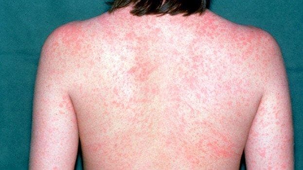 Nju-Jorku shpall emergjencën pas rritjes së rasteve të fruthit, 108 të infektuar
